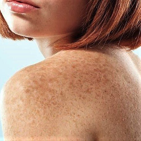 Melasma vs. Hyperpigmentation