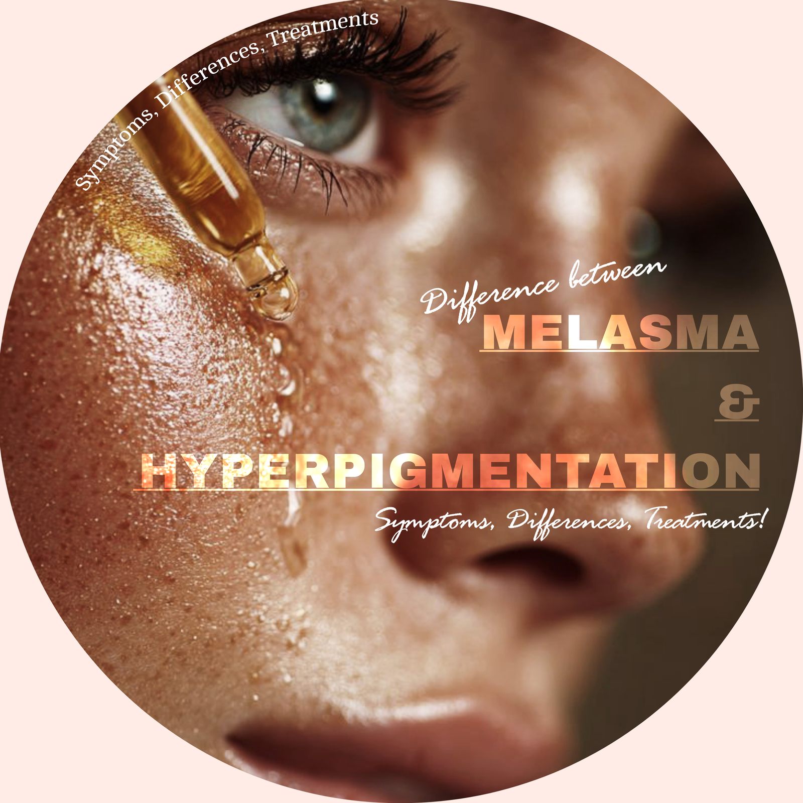 Melasma vs. Hyperpigmentation